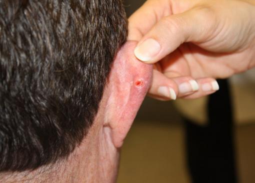 Basal cell carcinoma: a chronic condition? - A six-year study of patients with a history of basal cell carcinoma suggests that who have had multiple instances will continue to have new instances. There is neither preventive medication nor cure. Treatment involves removal of the lesions, above.