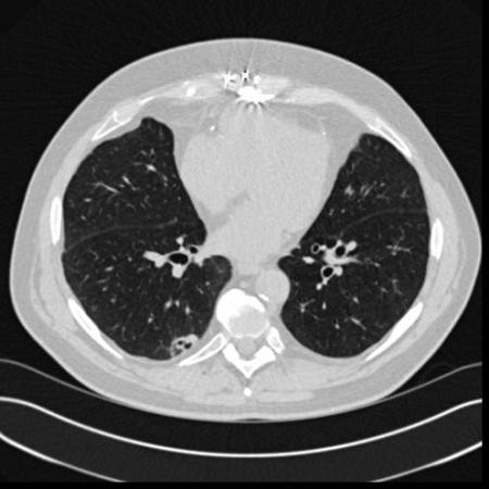 A better way to screen - Computed tomography examines the lungs from many perspectives. It reduced lung cancer deaths by 20 percent compared to using chest X-rays in a major national study.