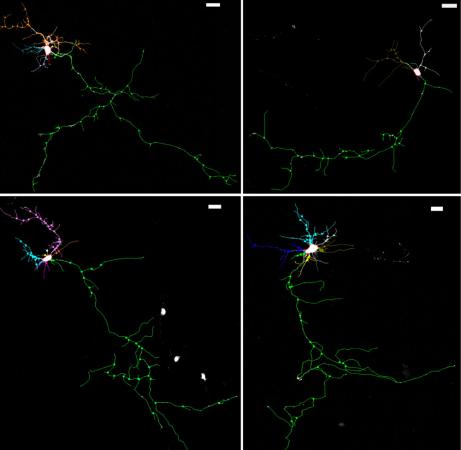 Bringing back branching - The neurotrophic factor BDNF restores neural branching growth in cells with NHE6 gene defects. The top row shows a neuron with no defect (left) and a less branched neuron with the NHE6 defect (right). Neurons below (no defect on the left, with defect on the right) received BDNF.
