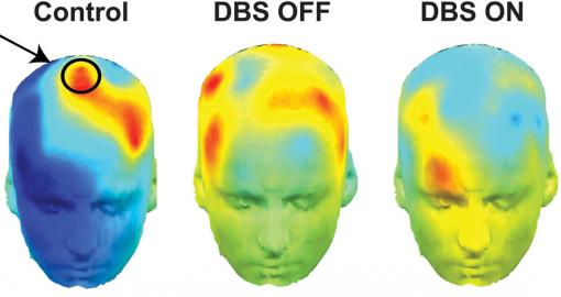 Red is for reflection - The hotter the color, especially in
the circled area, the more likely the brain was to take its time making difficult decisions. Parkinson's patients whose deep brain stimulators were on (right), were more impulsive — a cooler blue.