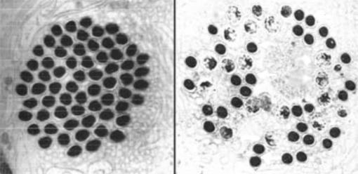 A subcellular life and death struggle - Healthy spermatids (maturing sperm) of a fly, left, are decimated in a setting dominated by a “segregation distorter,” right. A runaway snippet of code that rapidly copies itself helps target spermatids for fatal attacks.
