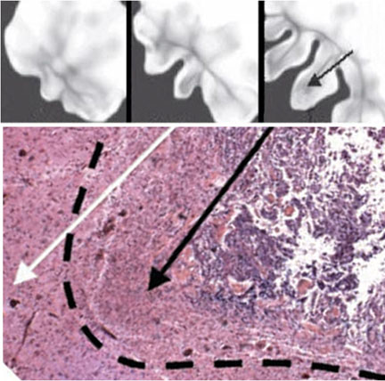 The virtual and the real: Computer-generated depictions of a growing brain tumor show growth at six, eight and 12 months (top, left to right), with development of infiltrative cell front (arrow) at 12 months. Tissue slide (bottom) shows tumor finger (black arrow) advancing in substrate gradient (white arrow).
