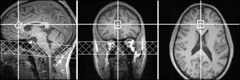 Adhd Drugs Increase Brain Glutamate >> Adhd Drugs Increase Brain Glutamate Predict Positive Emotion In Adhd Drugs Increase Brain Glutamate >> Adhd Drugs Increase Brain Glutamate Predict Positive Emotion In